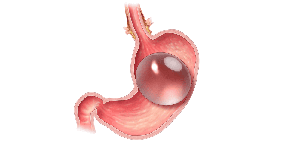 Intragastric Balloon